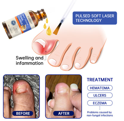 🐝🐝 Furzero™ Bee Venom Nail Fungus Treatment Solution: Completely Resolve Nail Fungus Problems 🌟👣