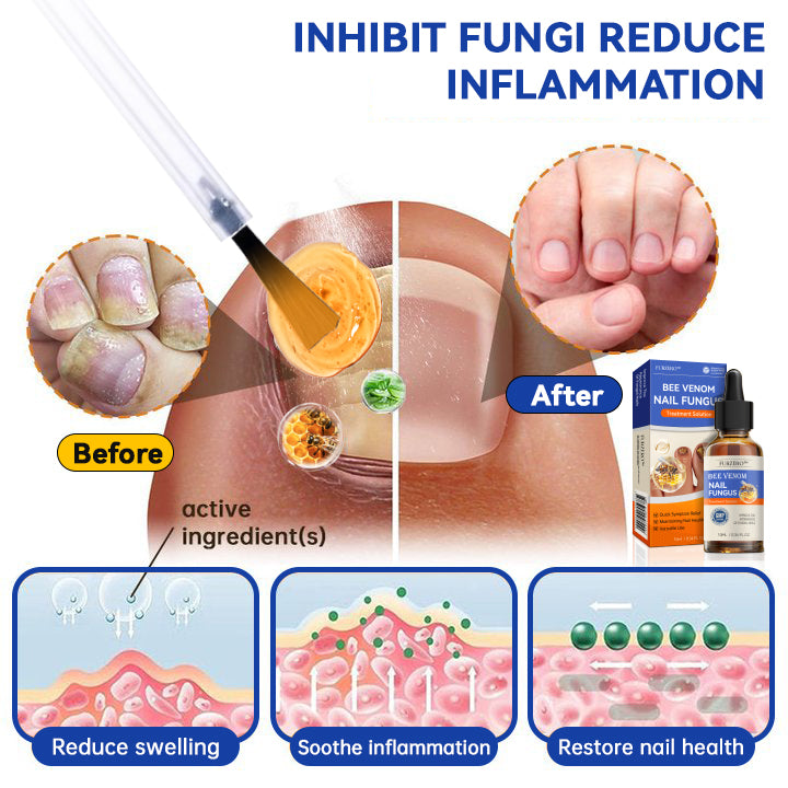 🐝🐝 Furzero™ Bee Venom Nail Fungus Treatment Solution: Completely Resolve Nail Fungus Problems 🌟👣