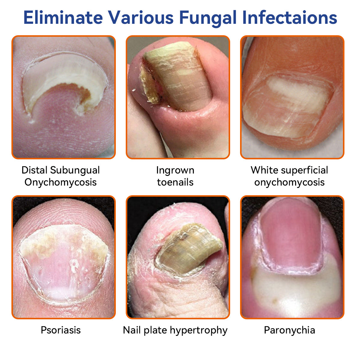 🐝🐝 Furzero™ Bee Venom Nail Fungus Treatment Solution: Completely Resolve Nail Fungus Problems 🌟👣