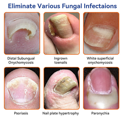 🐝🐝 Furzero™ Bee Venom Nail Fungus Treatment Solution: Completely Resolve Nail Fungus Problems 🌟👣