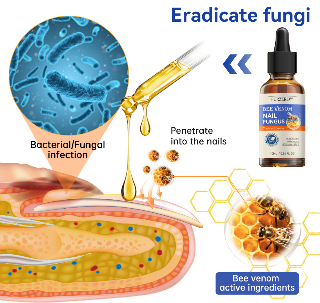 🐝🐝 Furzero™ Bee Venom Nail Fungus Treatment Solution: Completely Resolve Nail Fungus Problems 🌟👣